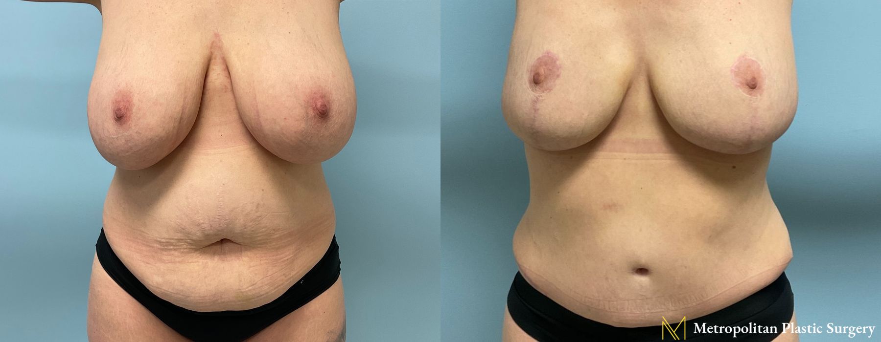 Before and after Abdominoplasty case 19254