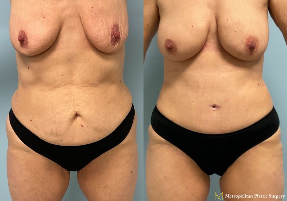 Fat Grafting - Case 191