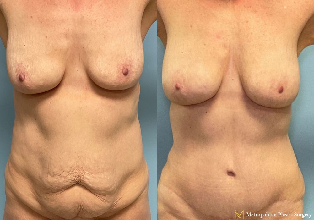 Liposuction - Case 219
