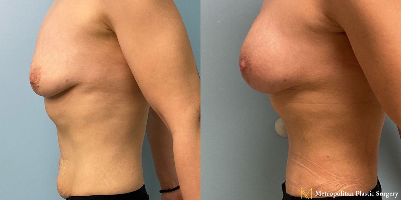Before and after Abdominoplasty case 23855 - Angle 2