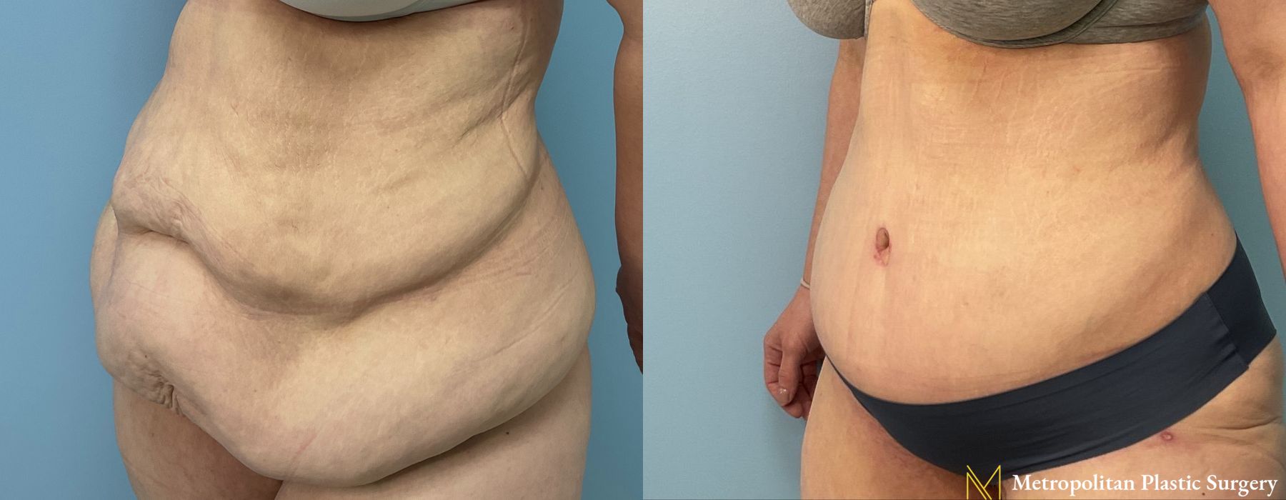 Abdominoplasty - Case 75