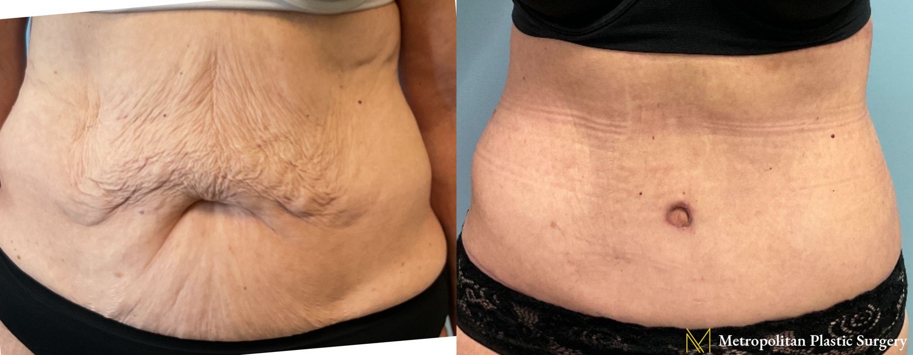 Before and after Liposuction case 26062
