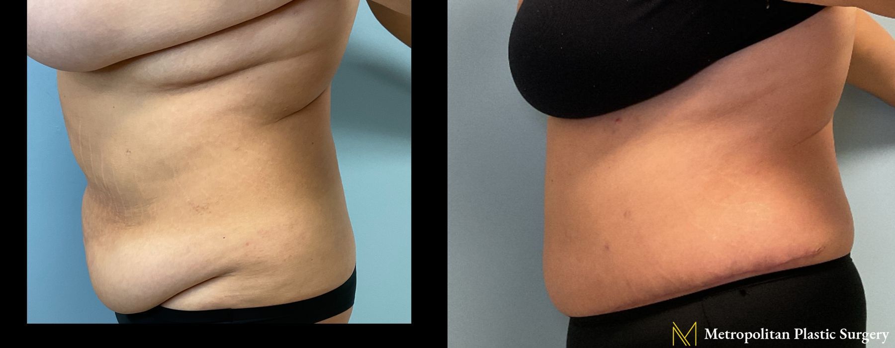 Before and after Liposuction case 26092 - Angle 2