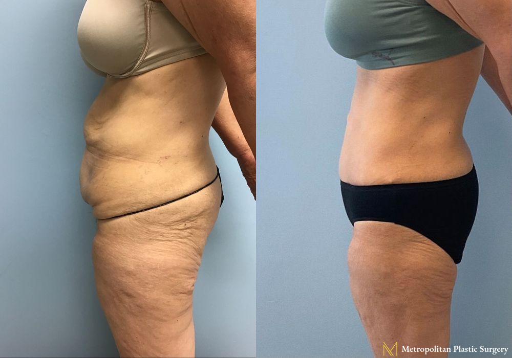 Abdominoplasty - Thumbnail 3