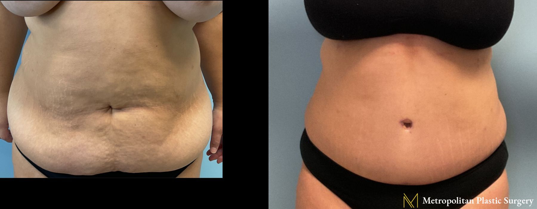 Liposuction - Case 217