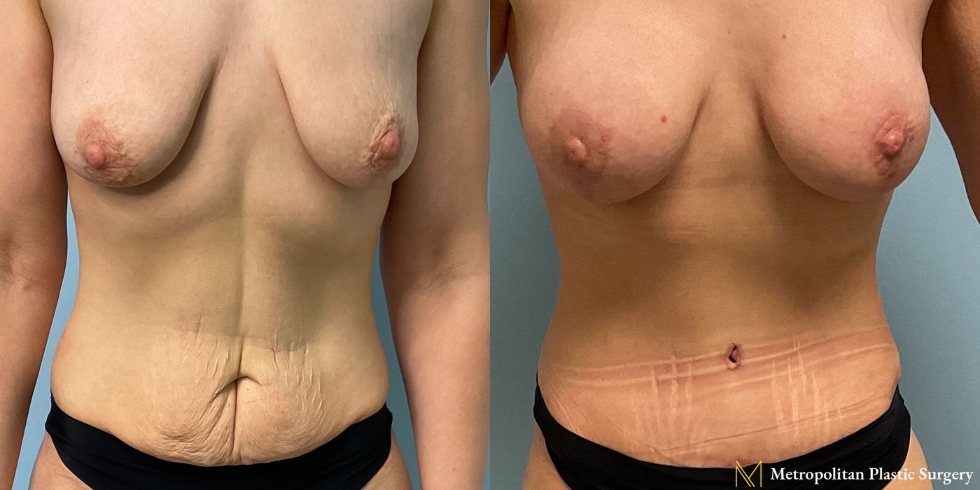 Before and after Abdominoplasty case 23855