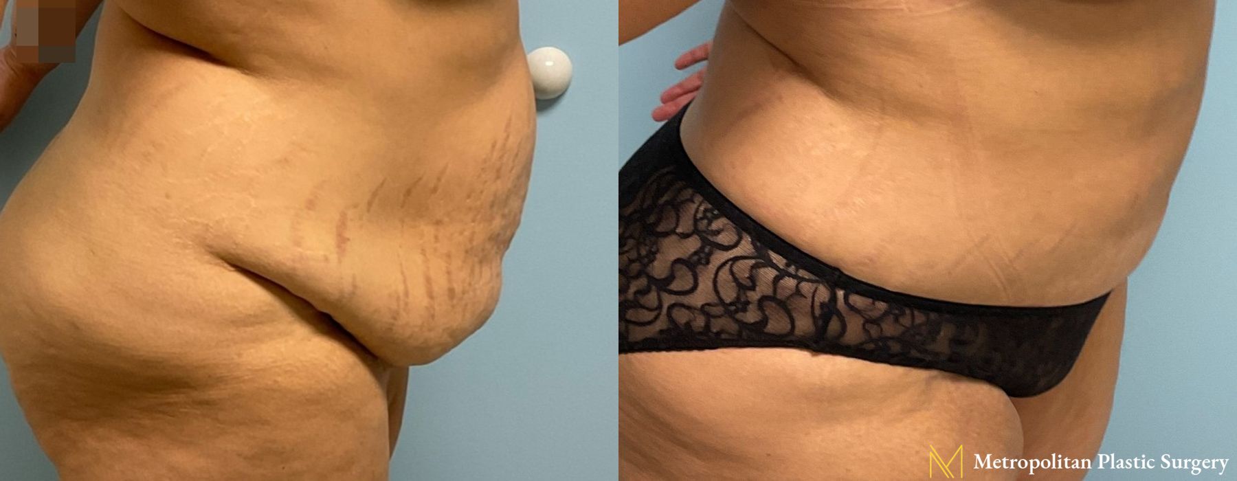 Abdominoplasty - Thumbnail 2