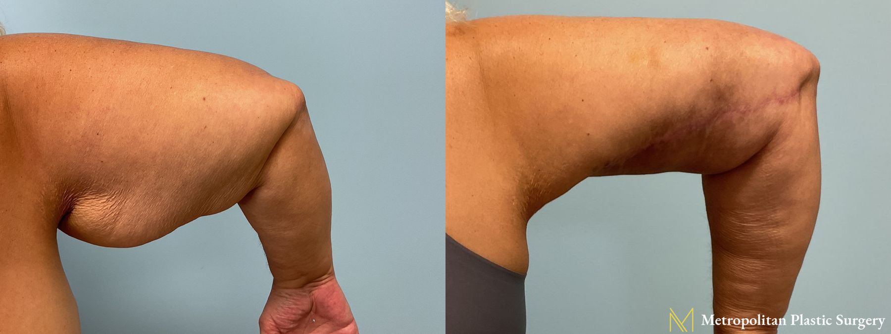 Before and after Liposuction case 41708 - Angle 3