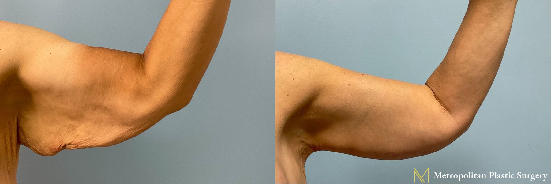 Arm Lift performed by Dr. Julia Spears - Angle 3