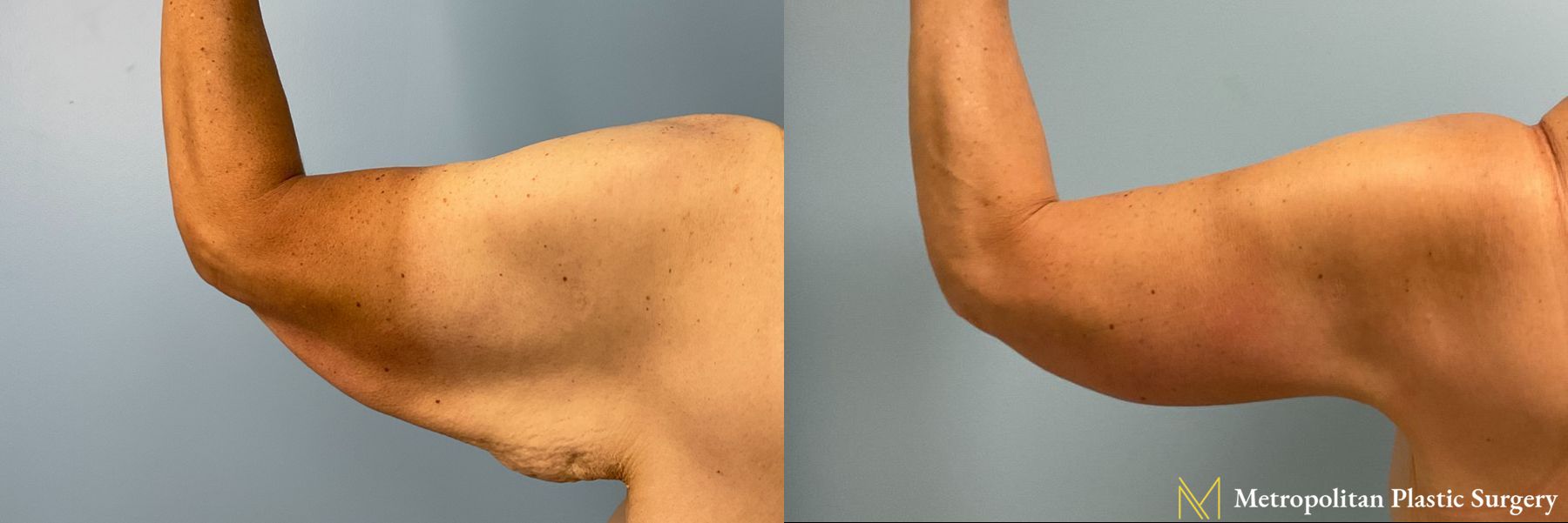 Arm Lift performed by Dr. Julia Spears