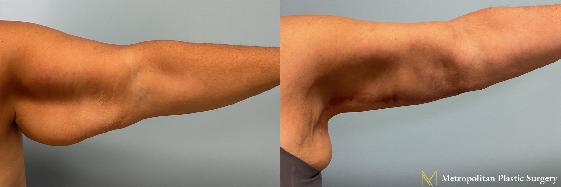 Before and after Arm Lift case 41708 - Angle 2