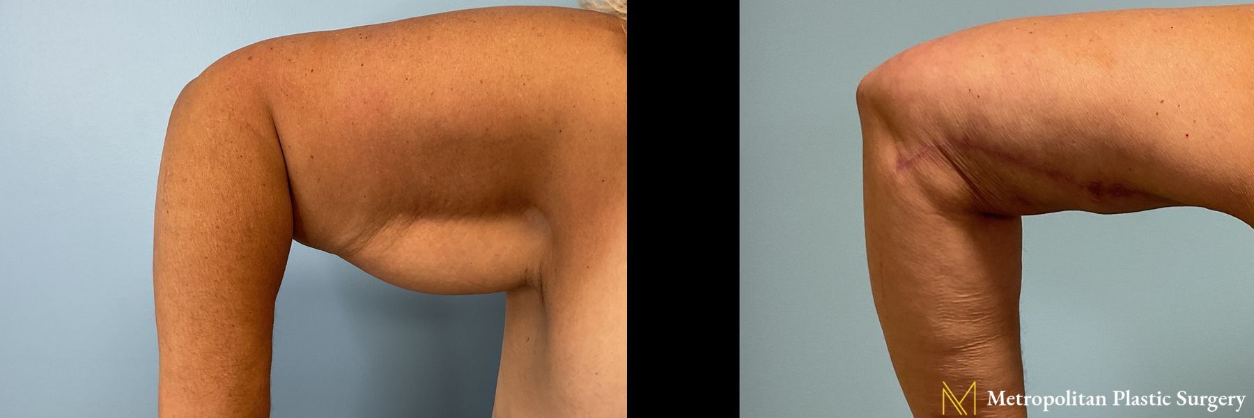 Before and after Arm Lift case 41708