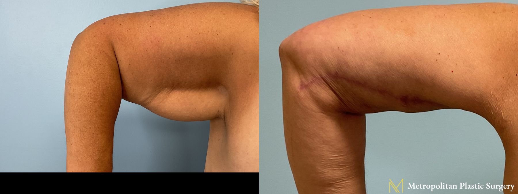 Before and after Liposuction case 41708