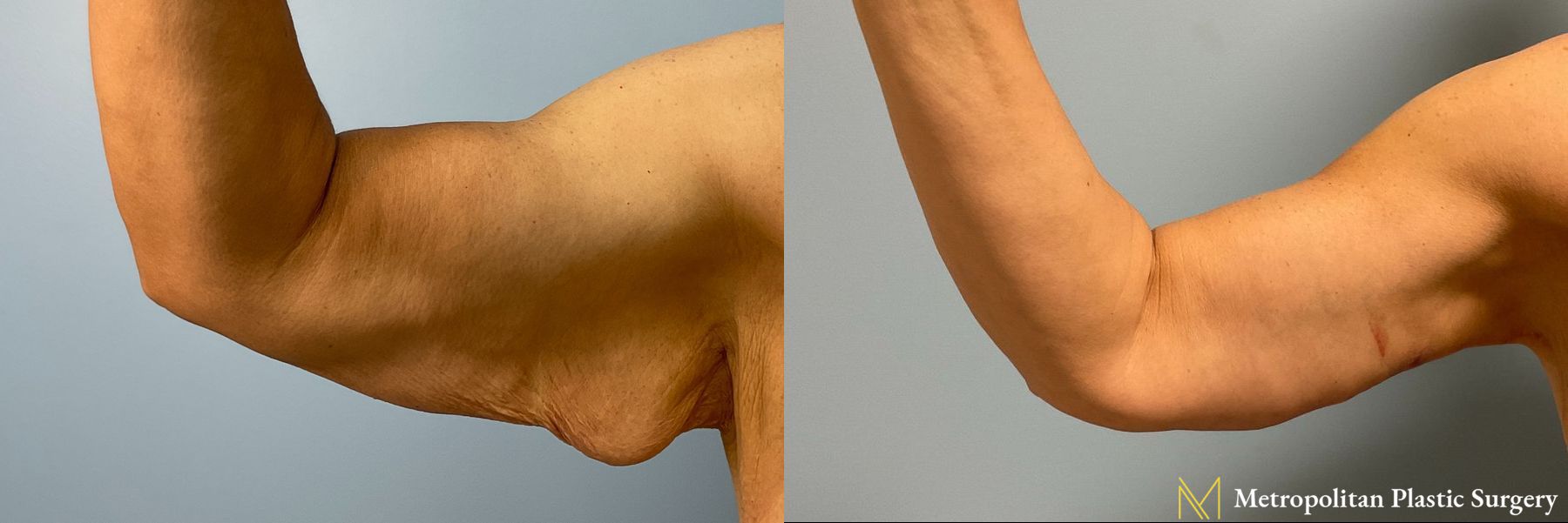 Arm Lift performed by Dr. Julia Spears - Angle 4