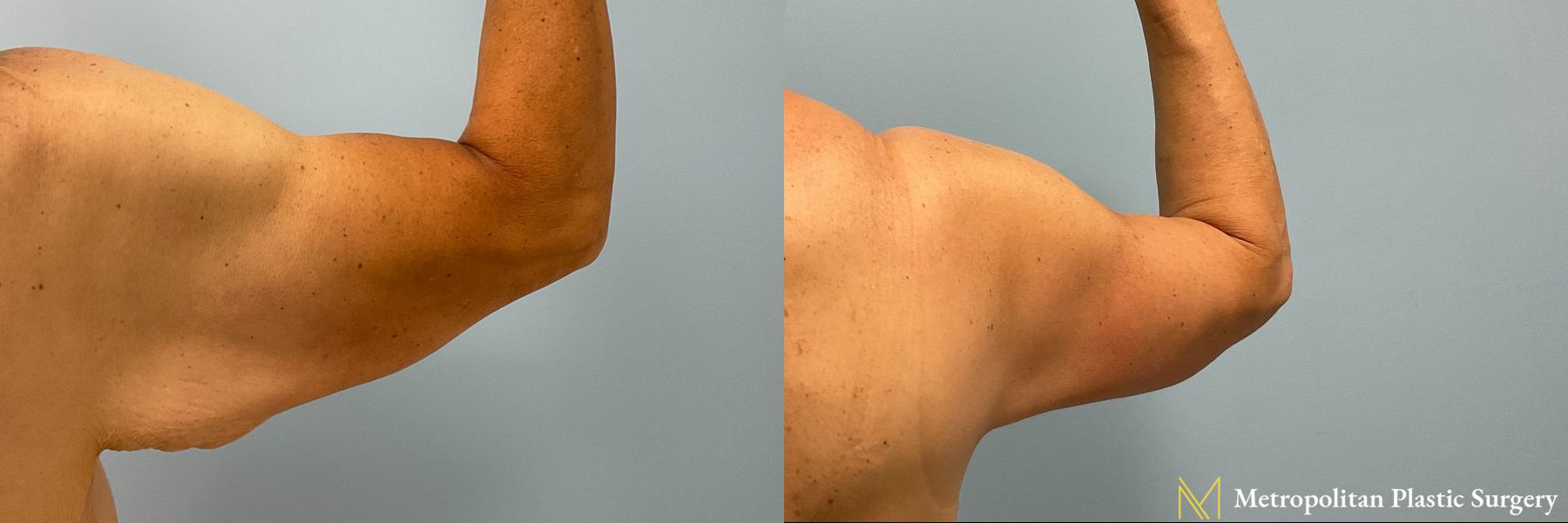Arm Lift performed by Dr. Julia Spears - Angle 2