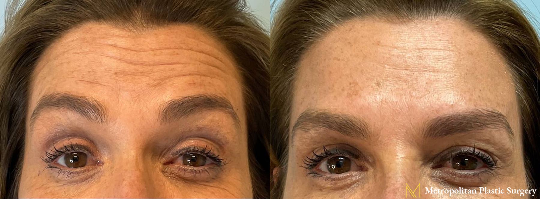 Before and after Botox treatment to erase wrinkles and lines.