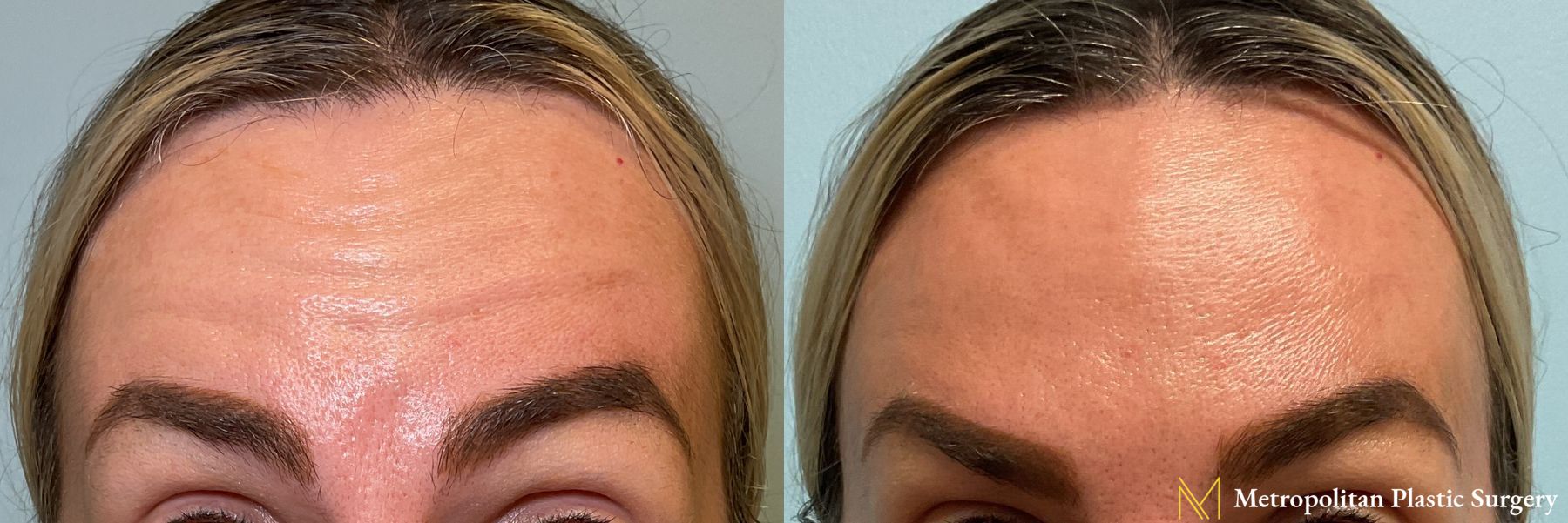Botox performed by Dr. julia Spears