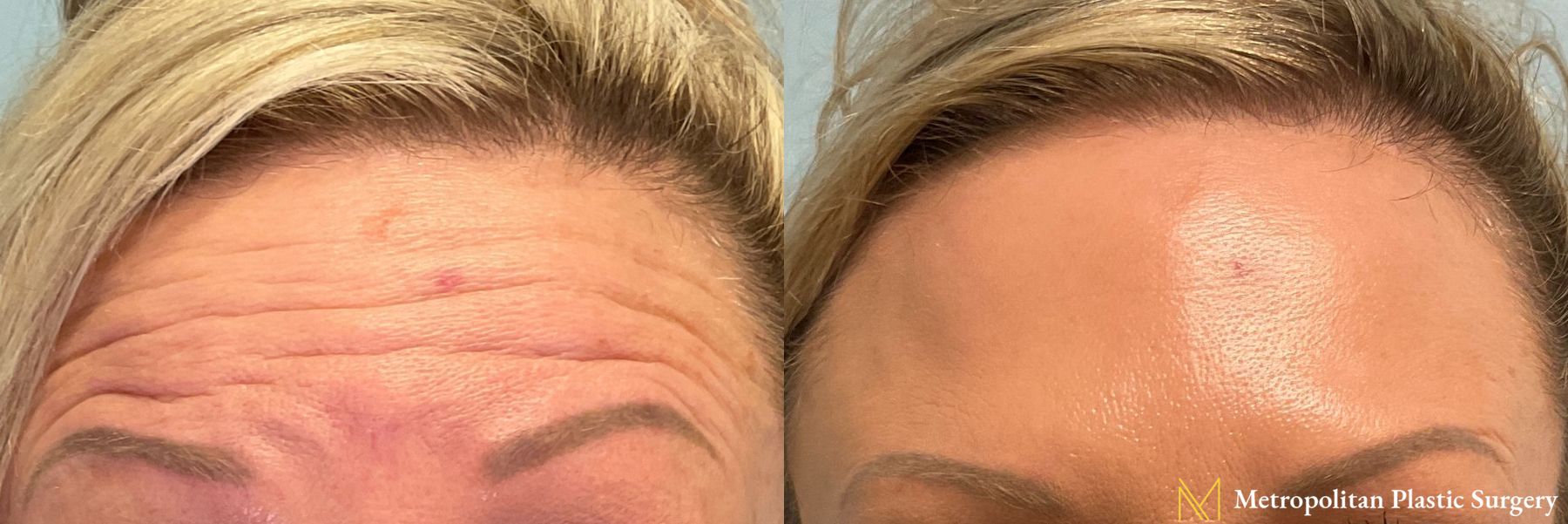 Before and after BOTOX® Cosmetic case 41759