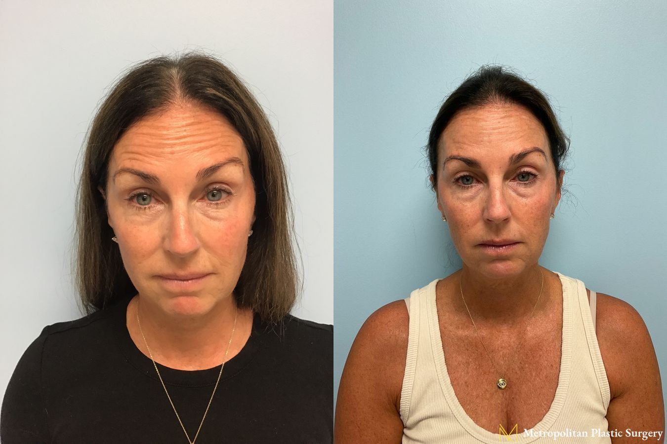 Before & after Botox Cosmetic application photos.