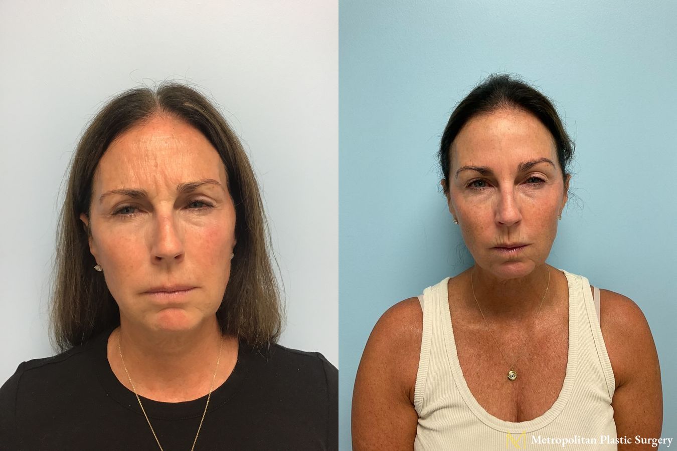 Before & after Botox Cosmetic application photos. - Angle 2