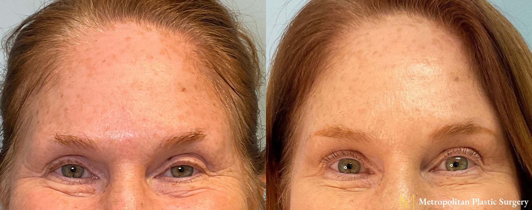 Before and after BOTOX® Cosmetic case 23986 - Angle 3