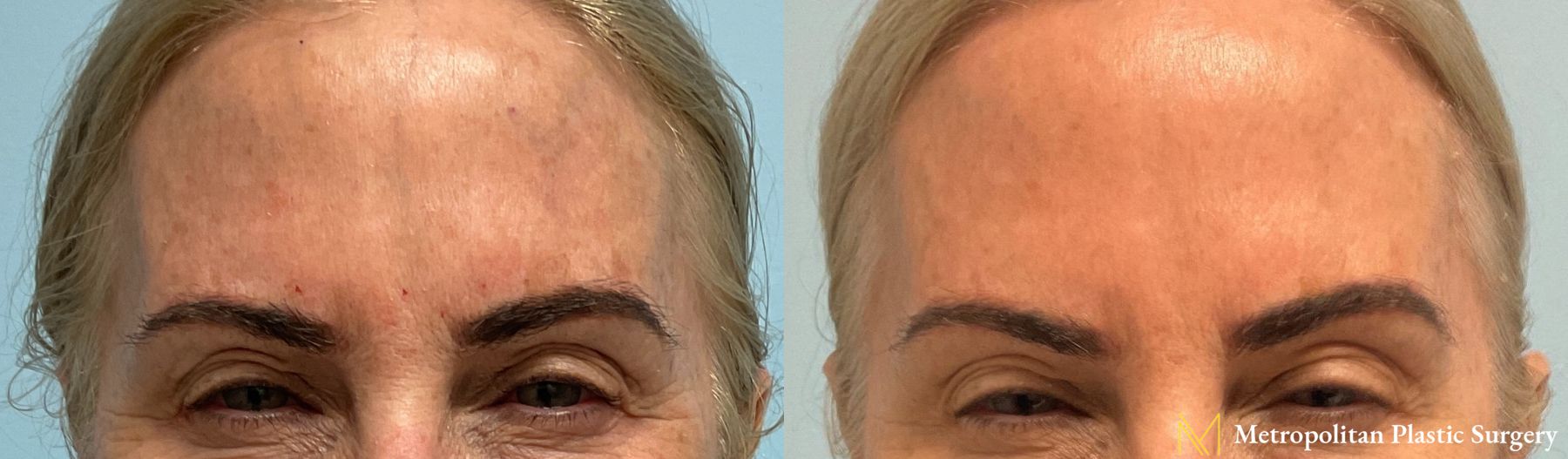 Before & after Botox Cosmetic application photos.