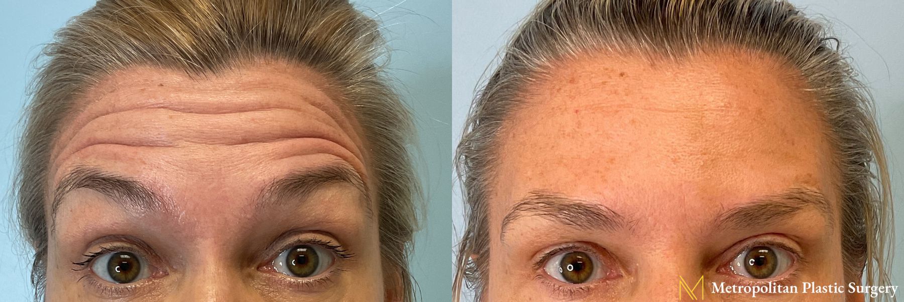 Botox performed by Dr. Julia Spears