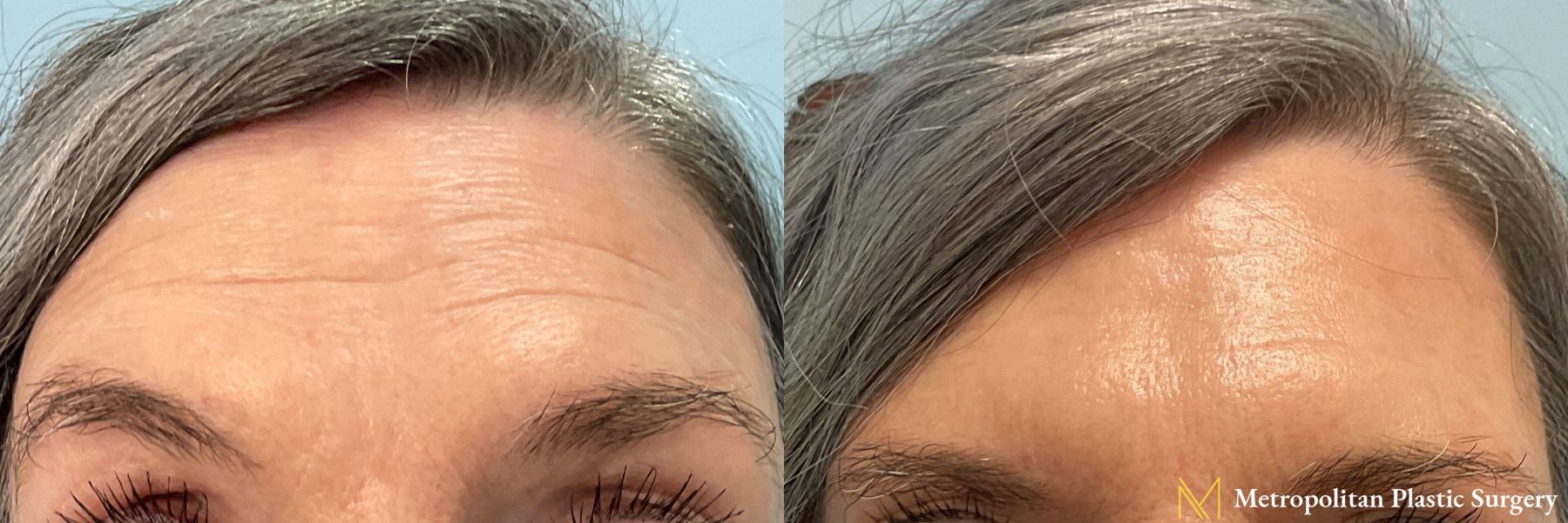 Botox performed by Dr. Julia Spears
