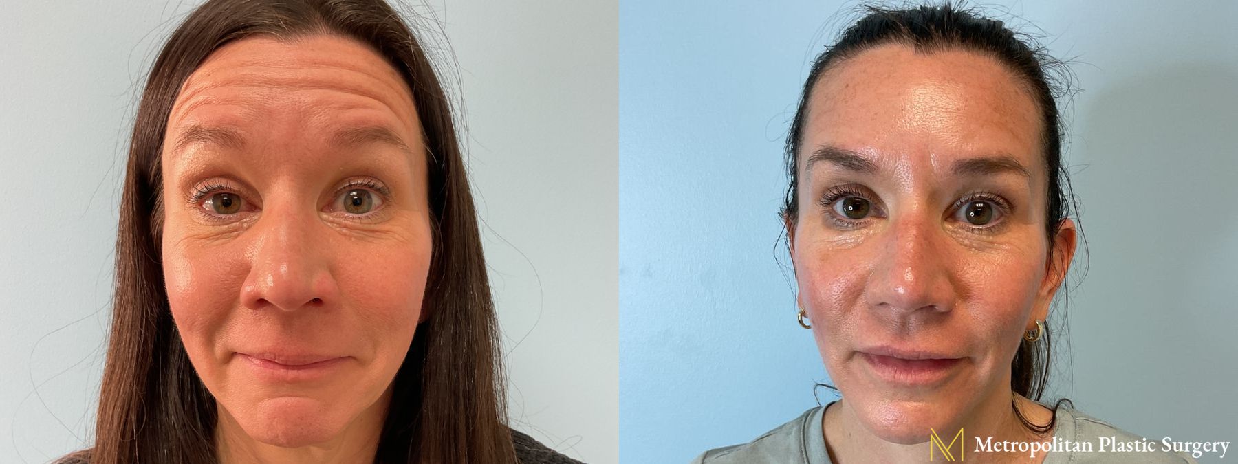 Botox performed by Dr. Julia Spears