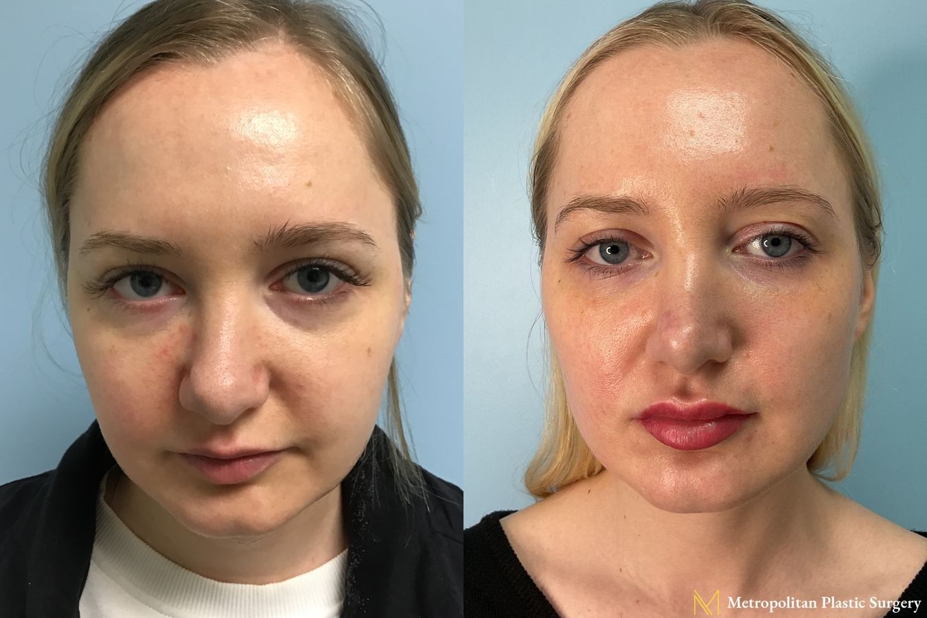 Before and after Fillers case 41740