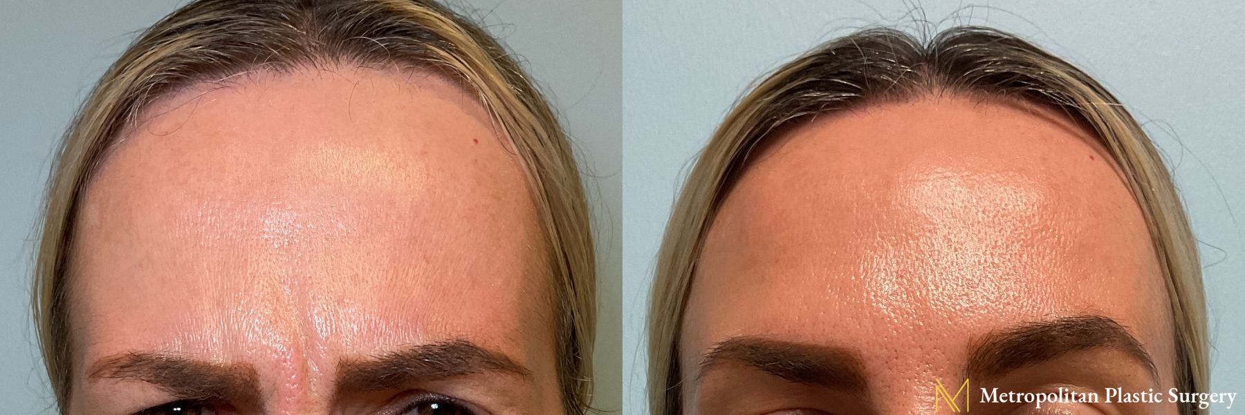 Botox performed by Dr. julia Spears - Angle 2