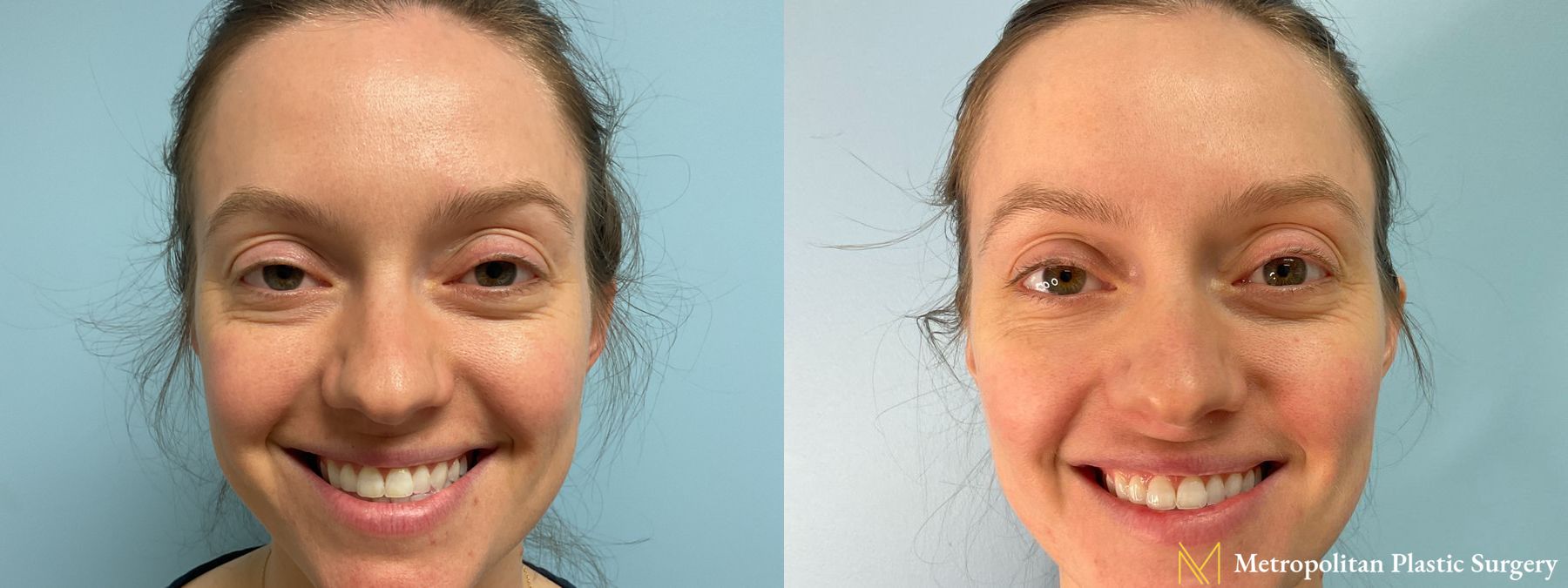 Before and after Lip Filler case 41747 - Angle 3