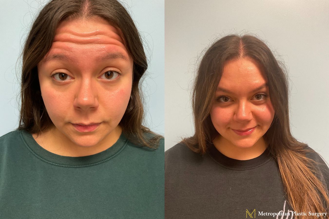 Before & after Botox Cosmetic application photos.