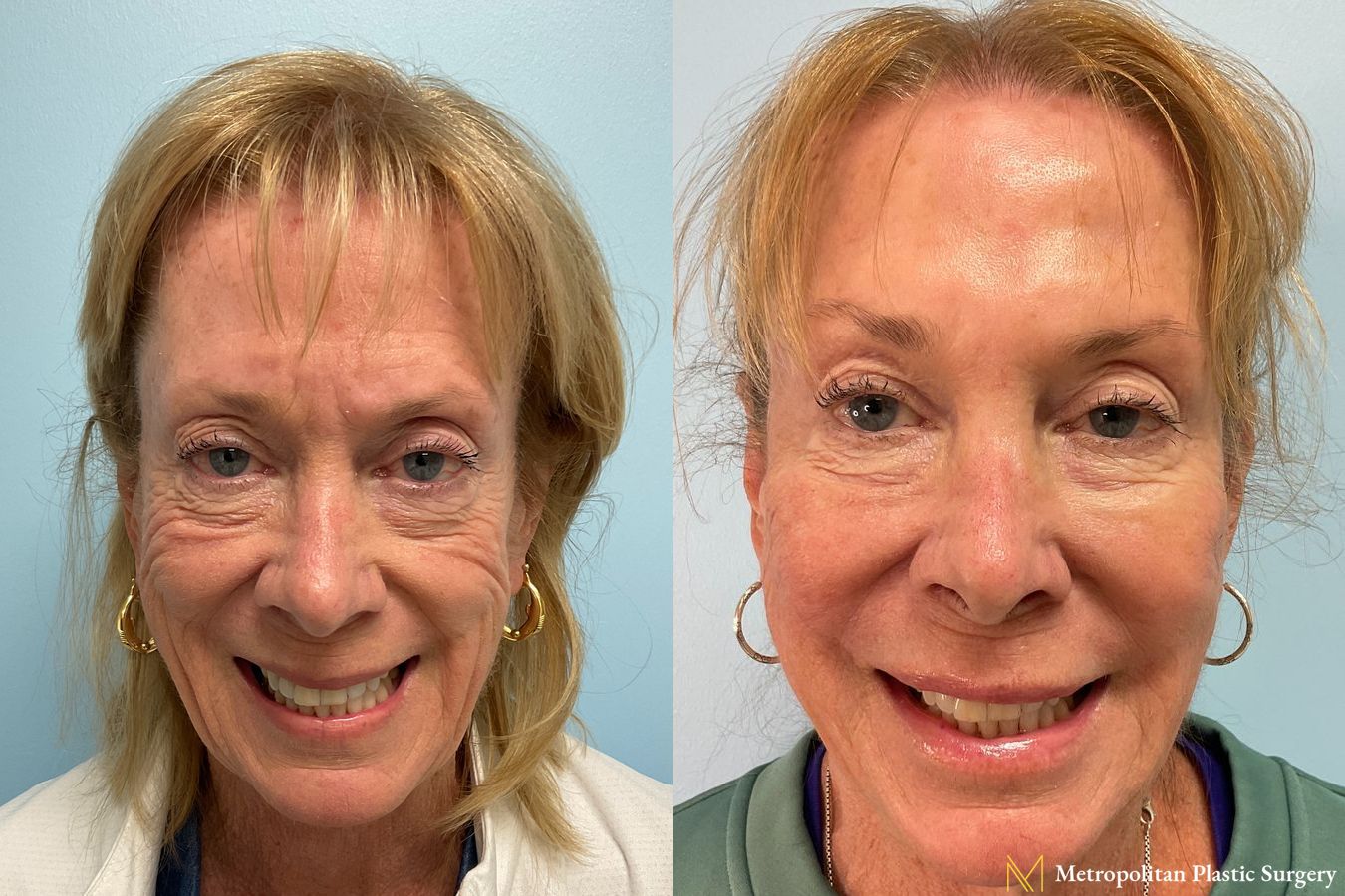 Before and after Fillers case 23845