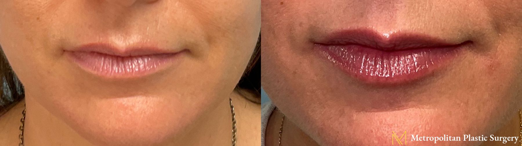 Botox performed by Dr. Julia Spears