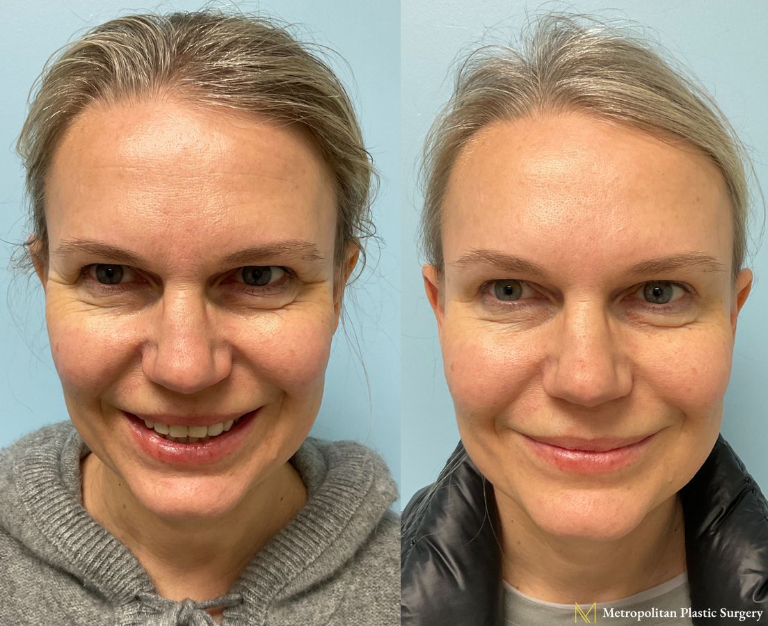 Botox injections to Forehead, Upper Lip, Frown Lines , and Crows Feet performed by Dr. Julia Spears at Metropolitan Plastic Surgery - Angle 2