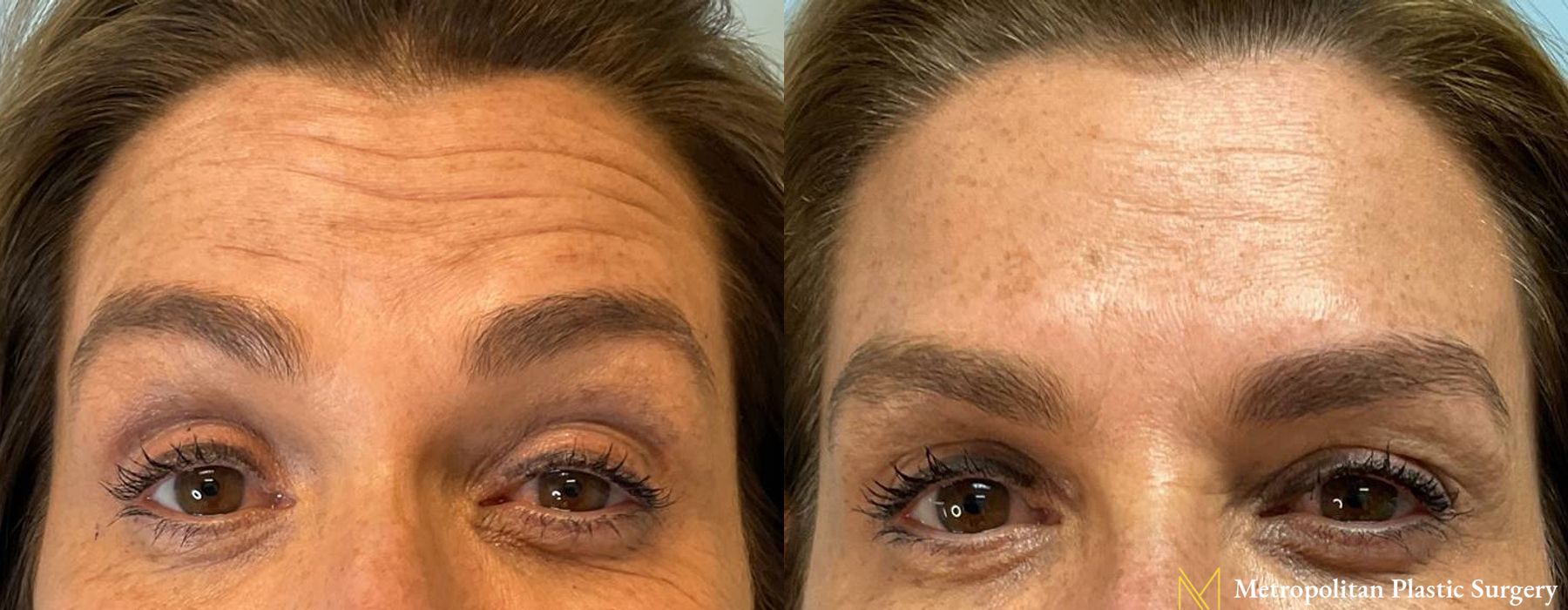 BOTOX® Cosmetic - Case 145