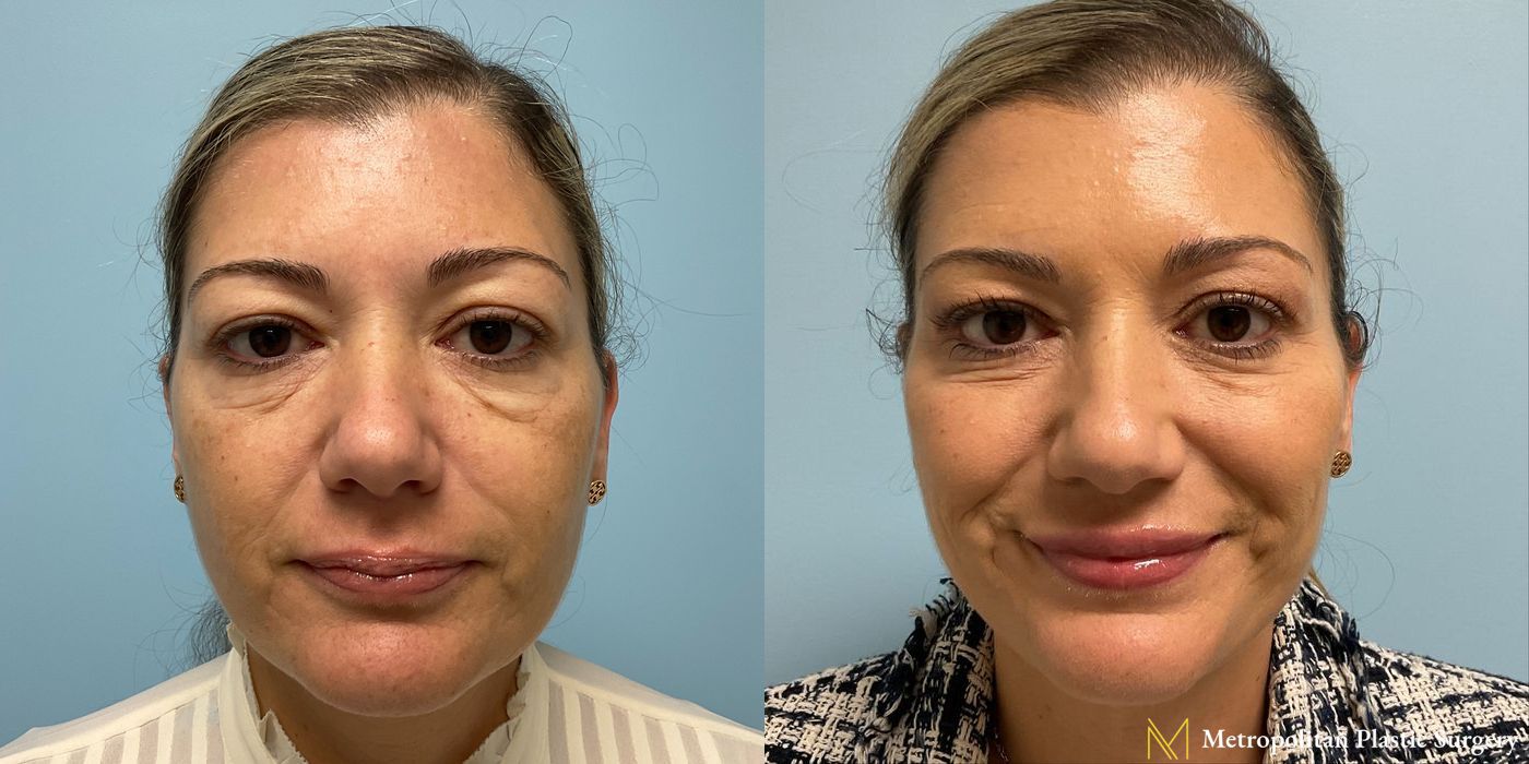Before and After Dermal Filler to erase Worry Lines or Wrinkles