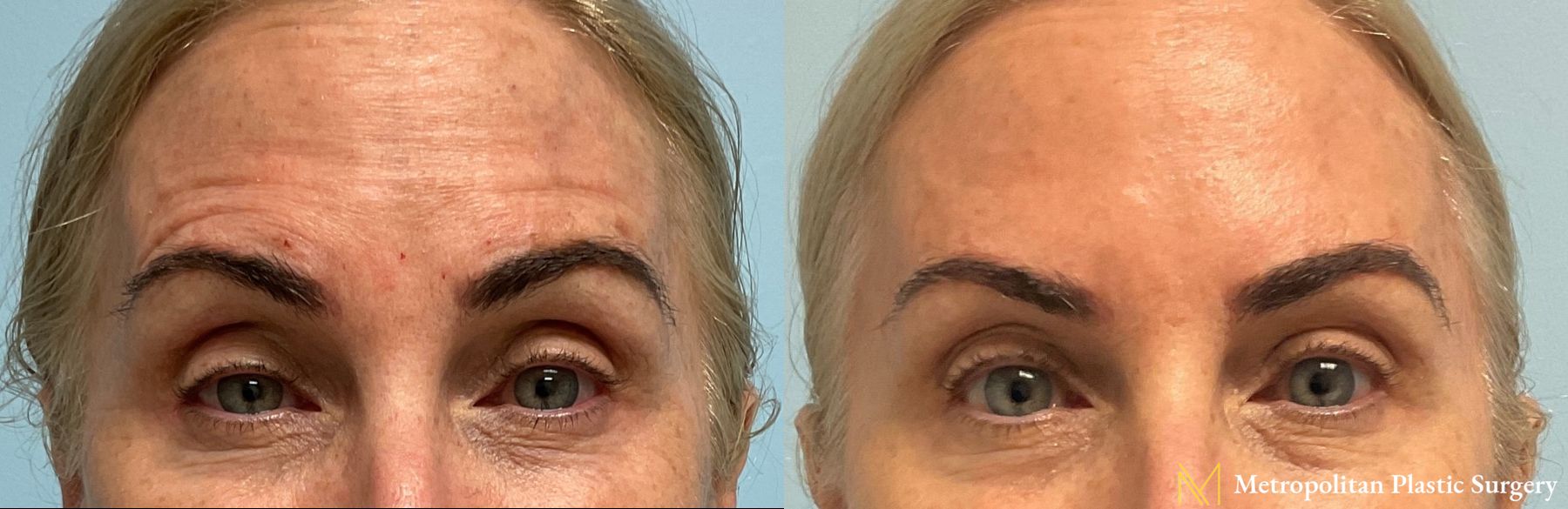 Before & after Botox Cosmetic application photos. - Angle 2