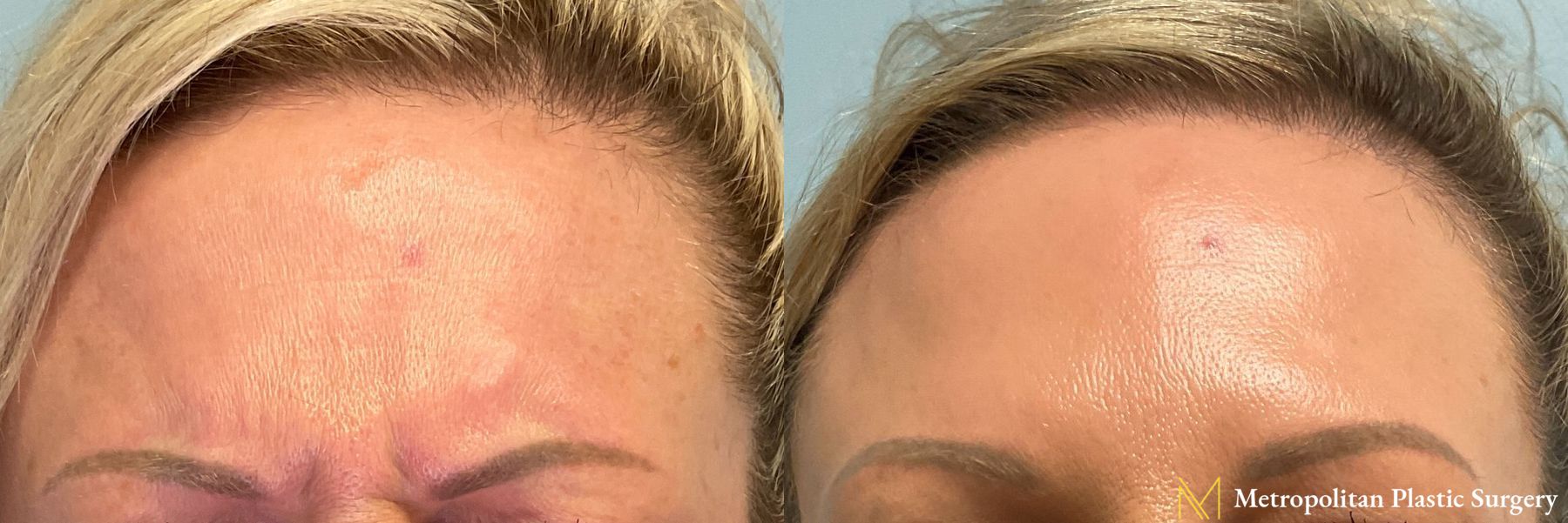 Before and after BOTOX® Cosmetic case 41759 - Angle 2