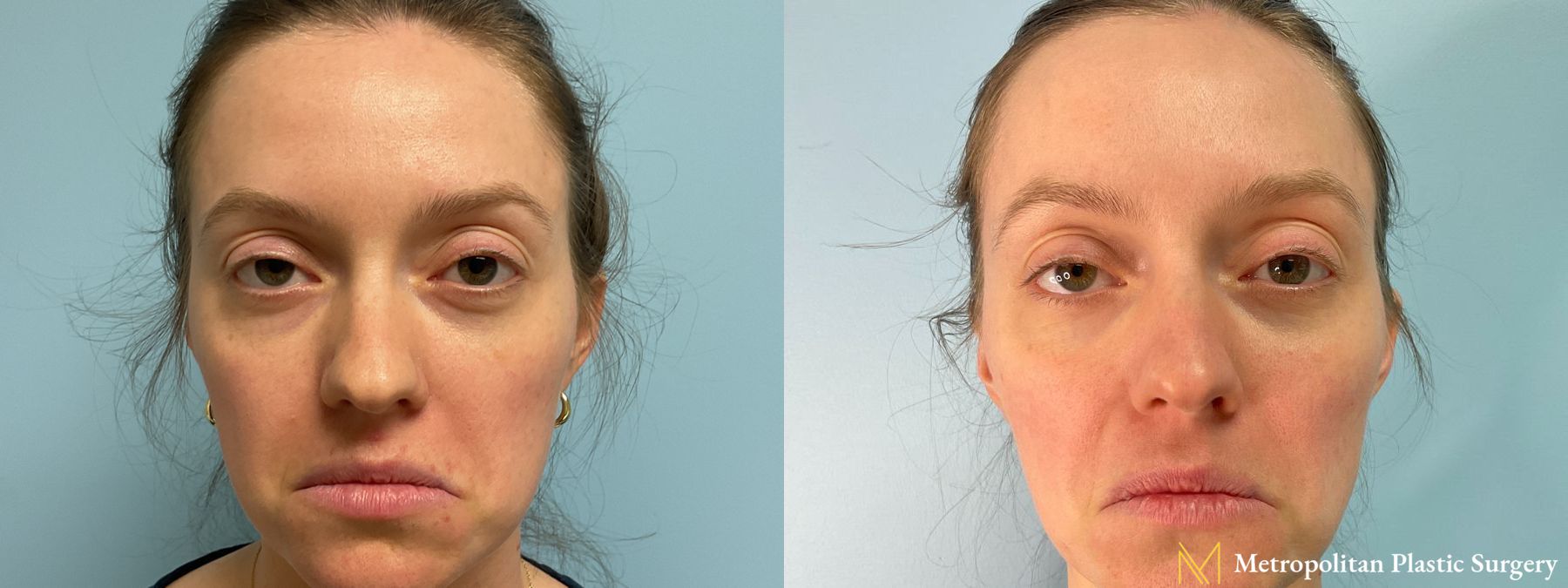 Before and after Lip Filler case 41747 - Angle 2