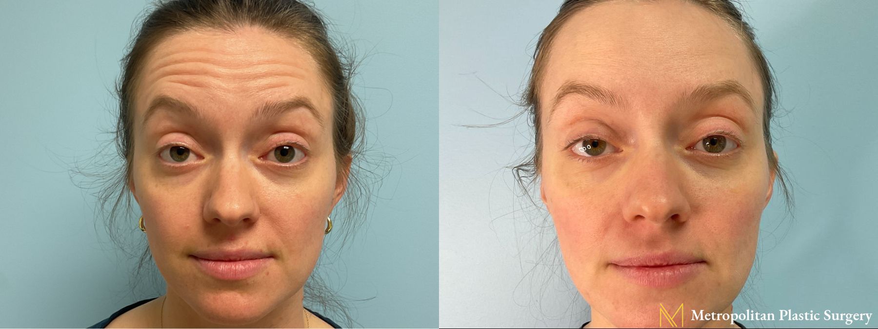 Before and after Lip Filler case 41747