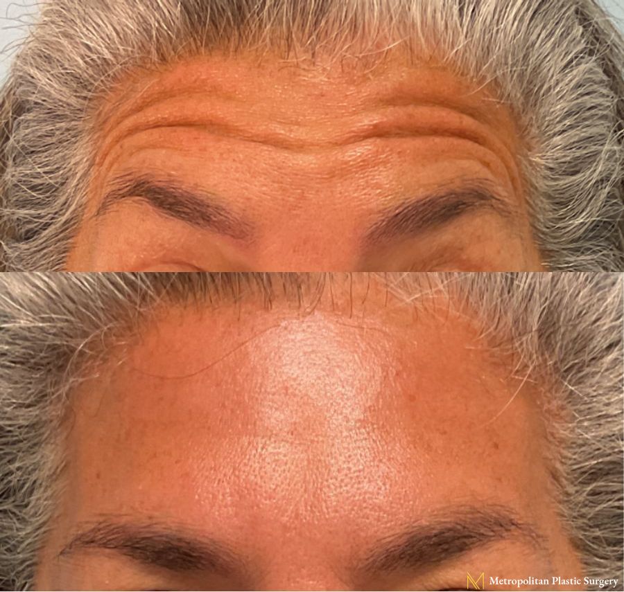 Botox performed by Dr. Julia Spears at Metropolitan Plastic Surgery in Marlton, NJ