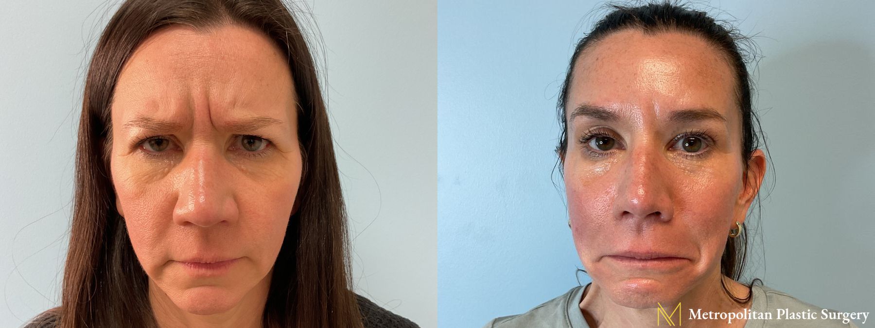Botox performed by Dr. Julia Spears - Angle 2