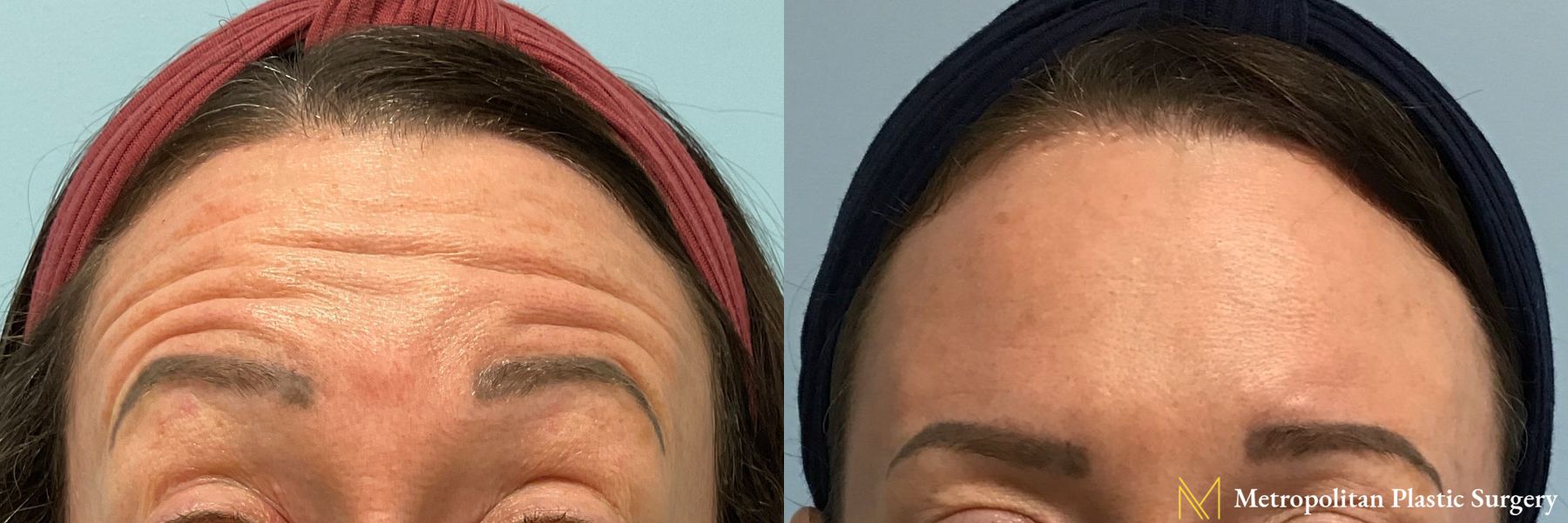 Botox performed by Dr. Julia Spears - Angle 2