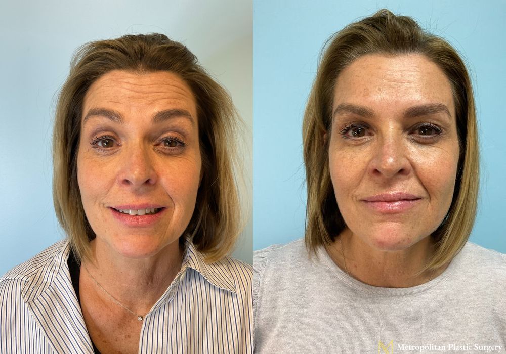 Before and after BOTOX® Cosmetic case 23812 - Angle 2