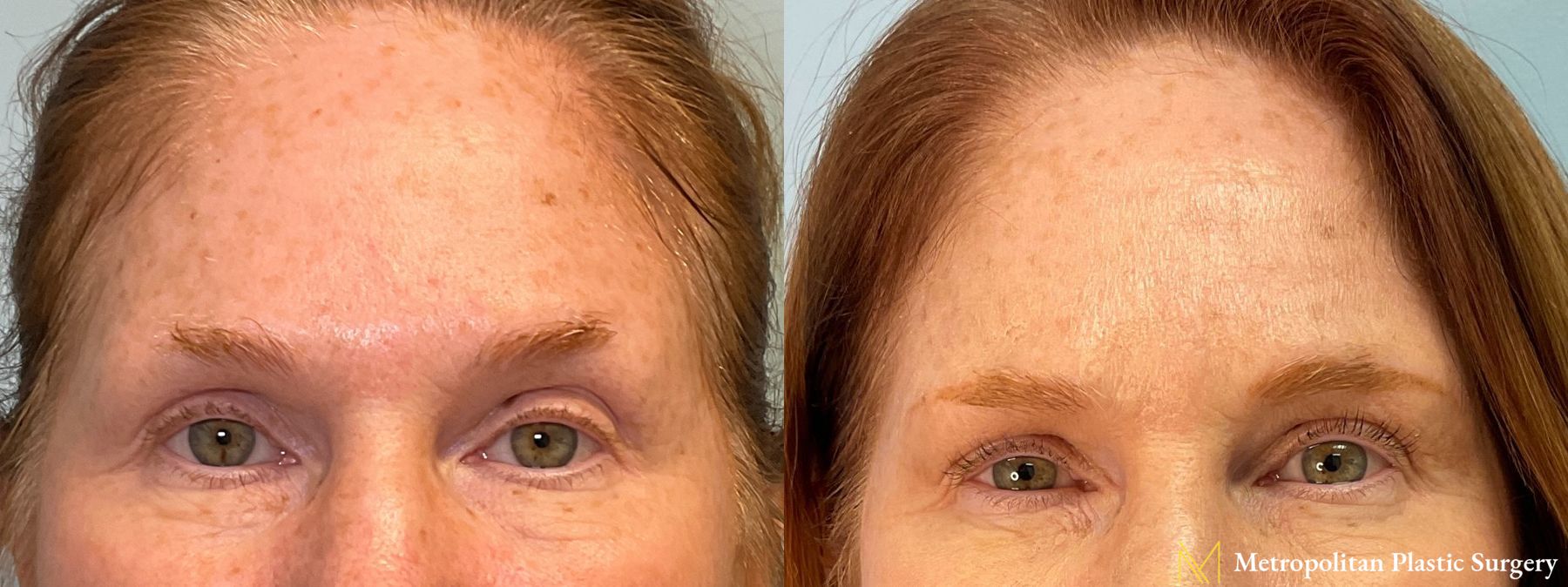 Before and after BOTOX® Cosmetic case 23986 - Angle 2