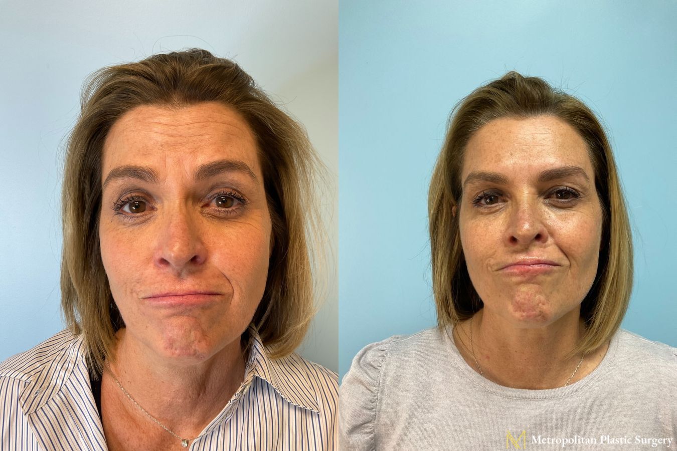 Before and after BOTOX® Cosmetic case 23812