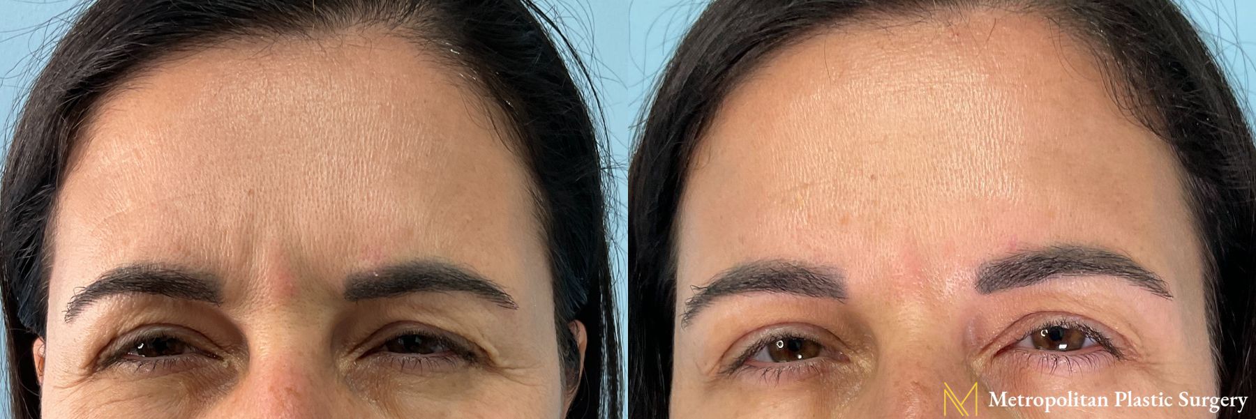 Botox performed by Dr. Julia Spears - Angle 2