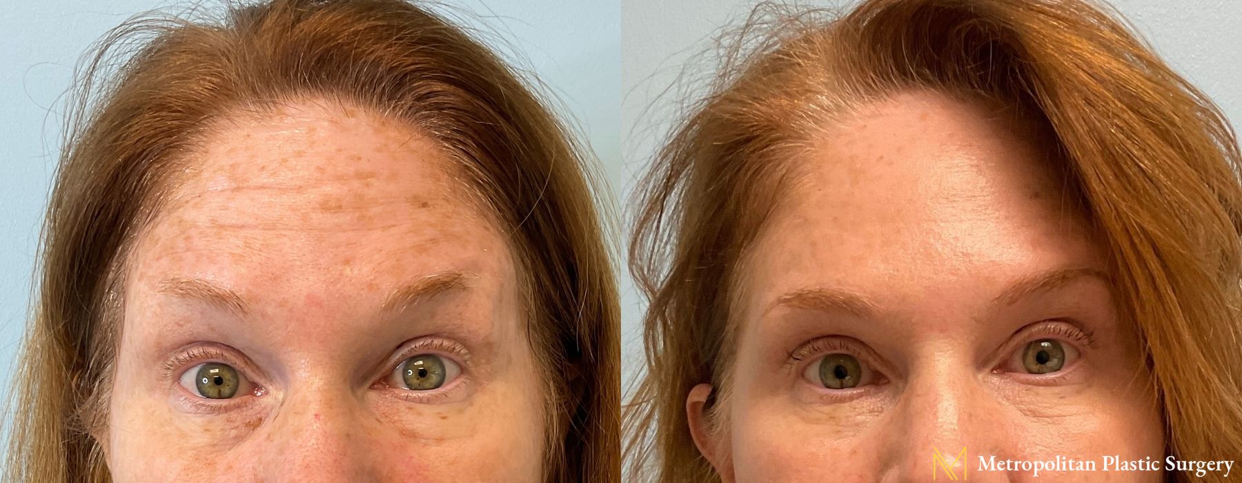 Before & After BOTOX to Erase Eyes Lines and Wrinkles